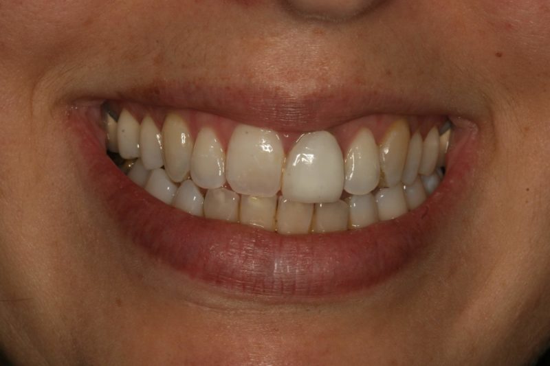 Patient photo showing before and after