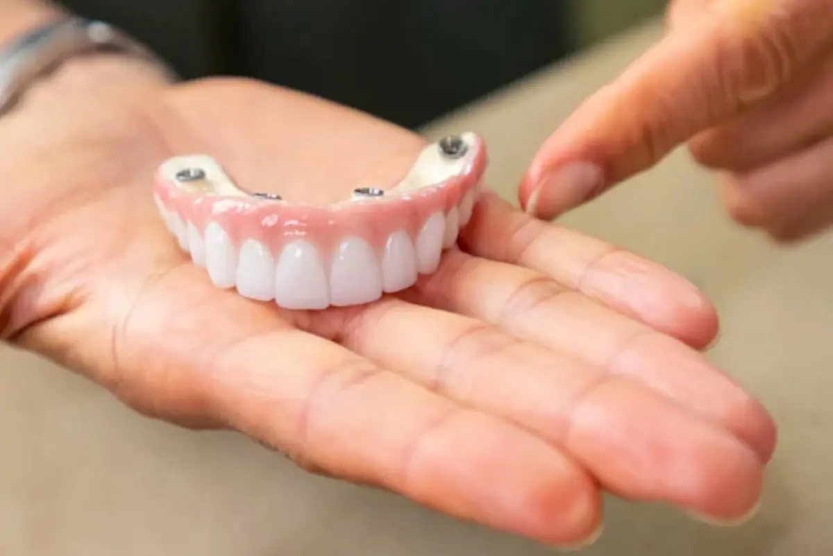 Image of a set of an implant-supported upper full-arch teeth.