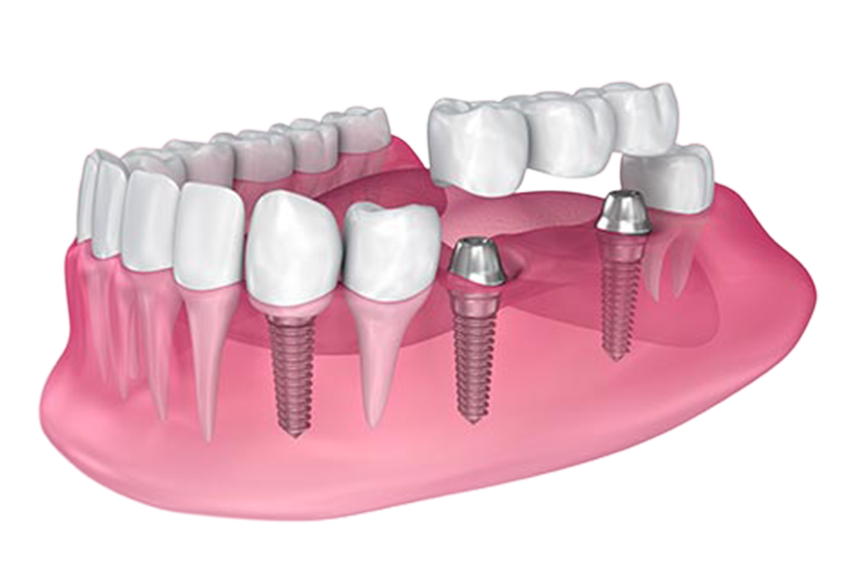 Single implant and bridge diagram