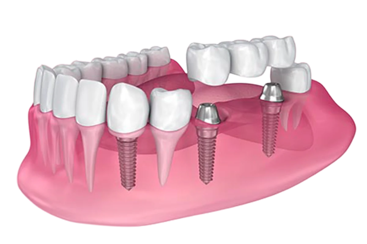 Single implant and bridge diagram