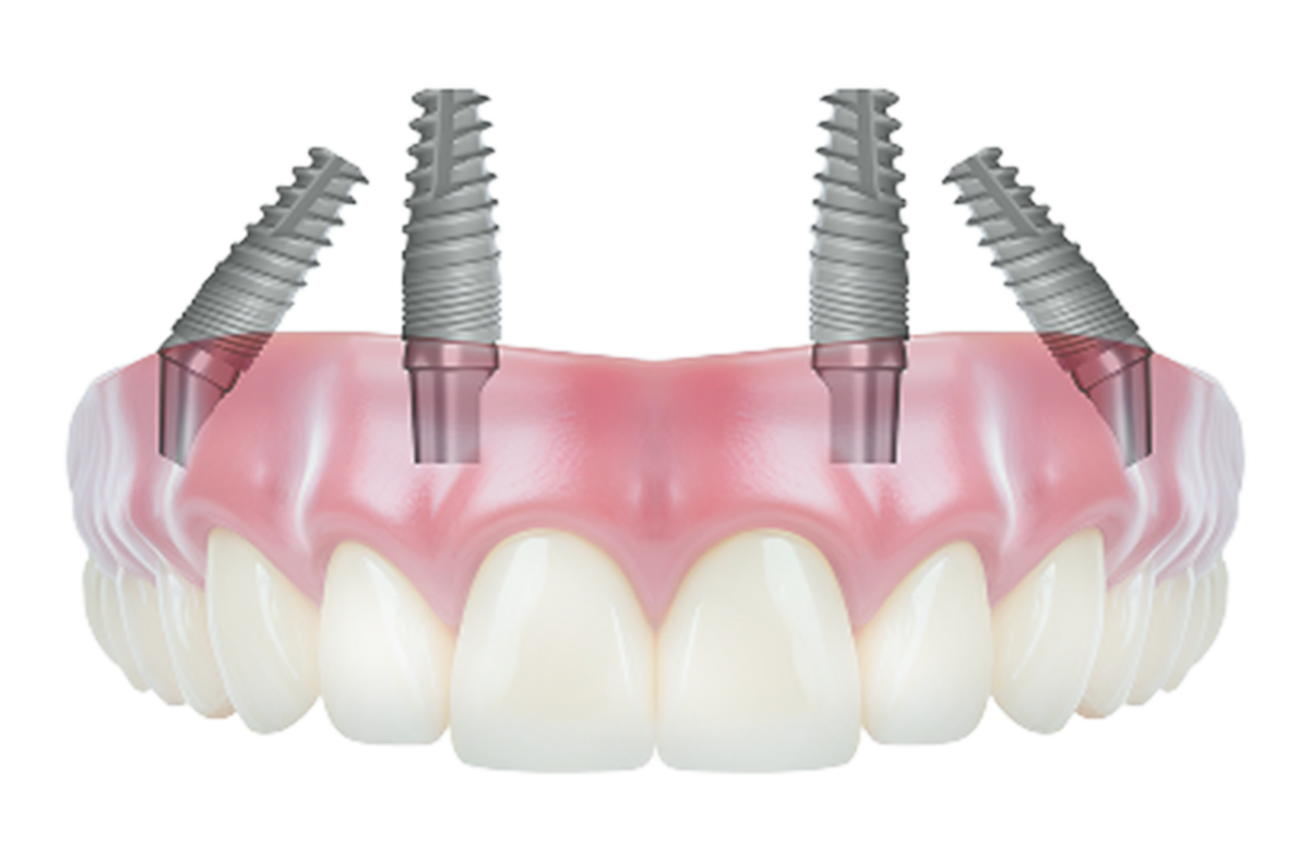 Same-day implant