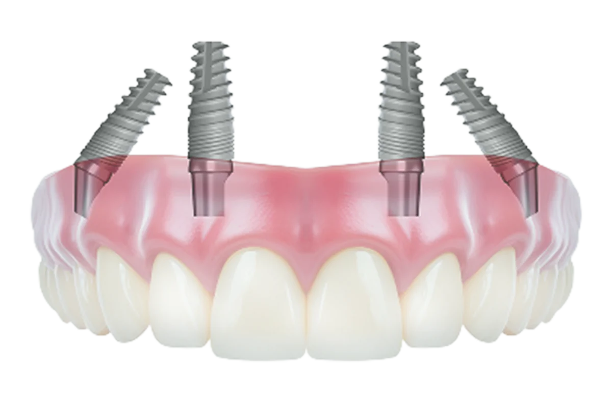 Same-day implant
