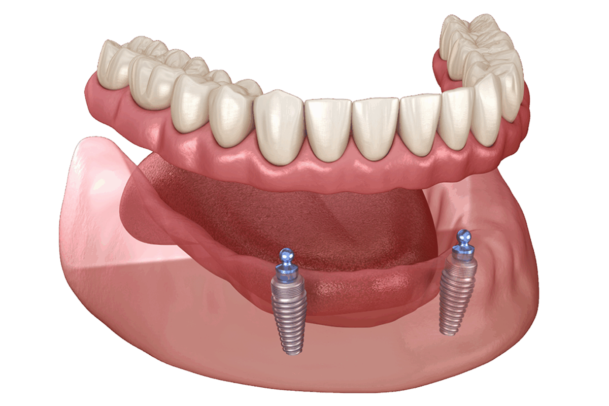 Snap-in Denture
