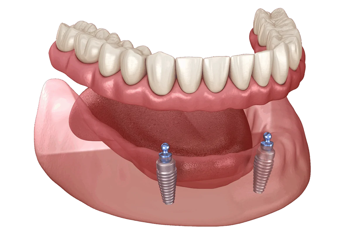 Snap-in Denture