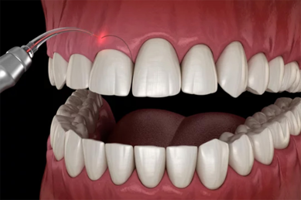 Gum recontouring
