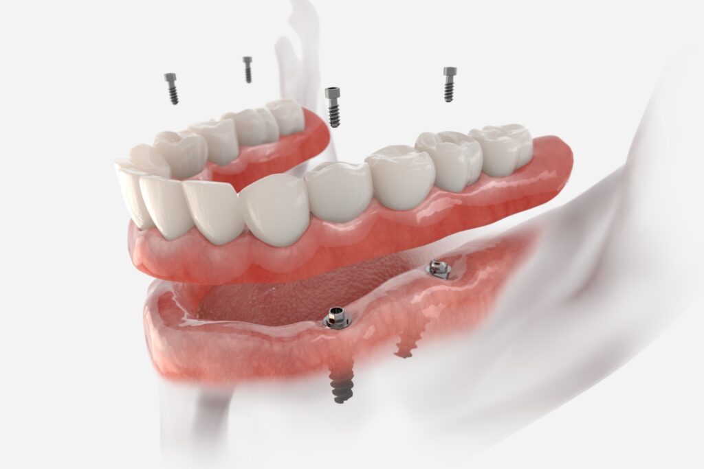 Mandibular fixed restoration with 4 implants, posterior are tilted. 3d illustration of implant on white background. Dental prosthetic innovation.